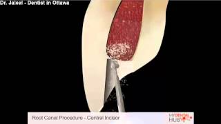 Endodontics  Root Canal Procedure Central Incisor  Dentist Ottawa [upl. by Hanoy]