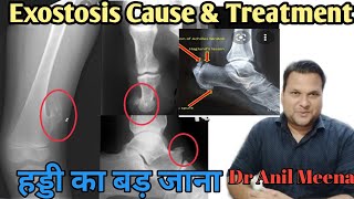 Exostosis Treatment  Exostosis cause and treatment  Osteochndroma  Osteophyte  Osteoma In Hindi [upl. by Jezreel]