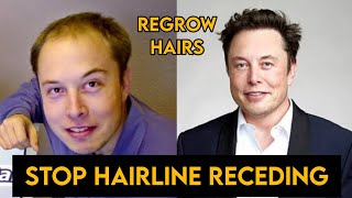 How to STOP RECEDING HAIRLINE and Regrow Hair Faster [upl. by Nivle]