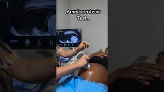 Amniocentesis Test Processes … Amniotic fluid from abdomen to rule out congenital defect [upl. by Ahsieni]