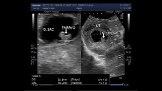 Ultrasound Video showing a case of missed miscarriage of about 7 to 8 weeks [upl. by Vadim406]