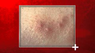 Signs of Bed Bug Bites  Health Checks [upl. by Ennailuj]