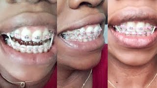 Braces Update Overbite extraction gaps tongue habit appliance pink Rubberbands [upl. by Htezzil728]