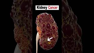 6 Ways to Lower Your Risk of Kidney Cancer kidneyhealth kidneycancer kidney [upl. by Ecinad]