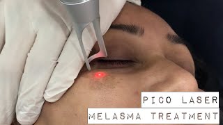 Melasma treatment with PICO Laser [upl. by Lonna542]