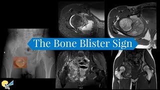 The Bone Blister Sign [upl. by Clementis]