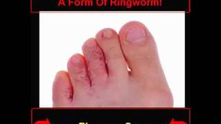 Ringworm Pics  How To Know If You Are Infected [upl. by Collyer]