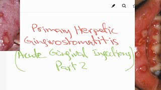 Primary Herpetic Gingivostomatitis  Acute gingival infections part2  Lecture [upl. by Junia]