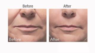 Botox vs Dermal Fillers [upl. by Yusem]