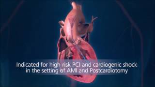 Impella® Heart Pump Animation For Physicians [upl. by Notgnimer]