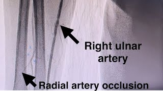 How To Puncture The Ulnar Artery in Ipsilateral Radial Artery Occlusion Anterior Puncture Technique [upl. by Arym]