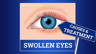 Swollen Eyelid Causes amp Treatment [upl. by Lefty]