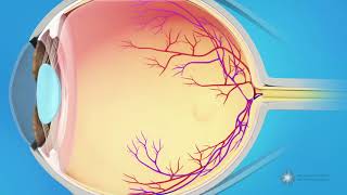 What causes a macular pucker [upl. by Vina]