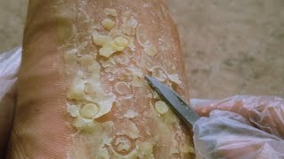 Satisfying Foot Callus Removal  Extreme Dead Skin Scraping Transformation [upl. by Paryavi]