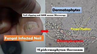 Fungal Infected Nail Microscopy showing Hyphae and Chlamydospores of Dermatophytes [upl. by Ariela]