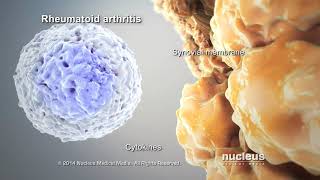 Rheumatoid Arthritis Animation  Cook Childrens [upl. by Childs]