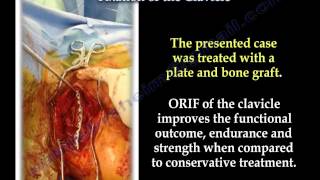 Clavicle fracture fixation  Everything You Need To Know  Dr Nabil Ebraheim [upl. by Rior]