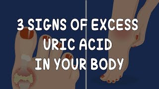 GOUT  3 Signs of Excess Uric Acid in Your Body  AzchanneL [upl. by Nnyled727]