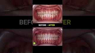 Underbite Braces evolution braces orthodontist dentist [upl. by Atinev]