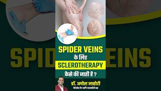 Treating Spider Veins with Sclerotherapy dramollahoti varicoseveins youtubeshorts [upl. by Ttej]