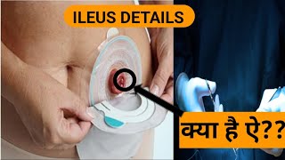 understanding ILEUS [upl. by Hoy]