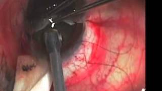 Intracapsular Cataract Extraction ICCE John Hovanesian MD [upl. by Rastus529]