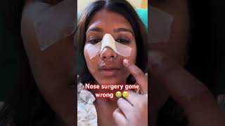 Rhinoplasty went wrong😢scam [upl. by Eseer]