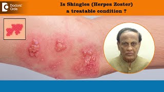 ShinglesHerpes Zoster Treatment  Post hepatic neuralgia pain amp cureDrD A SatishDoctors’ Circle [upl. by Jada]