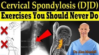 Cervical Spondylosis DJD Exercises You Should Never Do Correct Exercises  Dr Alan Mandell DC [upl. by Merkle]