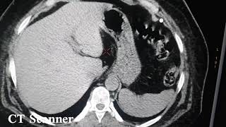 lithiase rénal TDM Abdominale sans injection [upl. by Aicala]