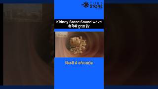 ESWL  Lithotripsy  Kidney Stone Treatment  Retrograde Intrarenal Surgery  shorts [upl. by Genevieve443]