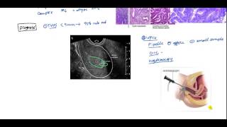 Endometrial Cancer and Hyperplasia for USMLE [upl. by Zilevi391]