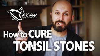 How to Cure Tonsil Stones [upl. by Fachanan264]