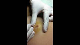 Sebaceous Cyst Extraction [upl. by Germaine816]