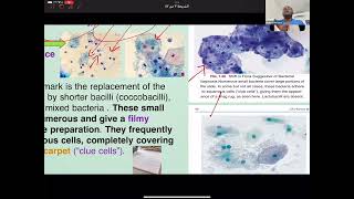 GYN Cytopathology  Bethesda system NILM Organisms [upl. by Emearg]