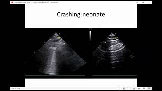 14 06 24 Dr Ahmad sherjil  Case Presentation Challenging Haemodynamic Case [upl. by Anidan]