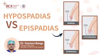 Hypospadias vs Epispadias  Dr Gautam Banga  SCI Hospital [upl. by Niaz]