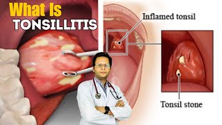 Tonsillitis  Causes Signs Treatment Symptoms In Hindi [upl. by Schwinn]