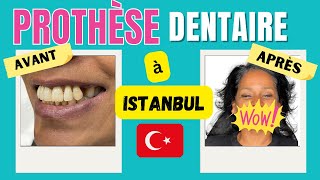 IMPLANTS DENTAIRES AVANT APRÈS à Istanbul je vous explique tout [upl. by Aivun739]