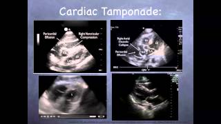 5 Understanding Arrhythmias  Cardiac Ablation [upl. by Gnehs]