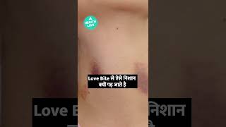 कभी सोचा है Hickey या Love Bite के ऐसे निशान क्यों पड़ते है  shorts  Health Live [upl. by Yddet487]