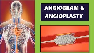 Angiogram and Coronary Angioplasty Procedure Cardiology [upl. by Akener]