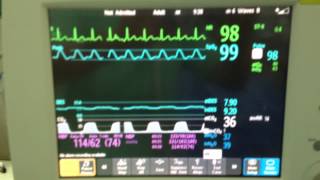 Desflurane in Morbid Obesity Washin Phase quot1112quot [upl. by Nylireg]