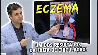 ECZEMA  UM DOS RESULTADOS DA FALTA DE CIRCULAÇÃO [upl. by Ahsropal982]