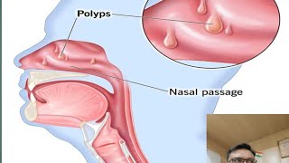 nasal polyps treatment nasal polyps nasal polyps homoeopathy treatment nasal symptoms [upl. by Almap]