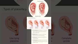 placenta previa  types of placenta previa  low lying placenta  partial amp complete placenta previa [upl. by Airdna]