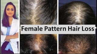 Hair loss in women  Female Pattern Hair Loss  causes amp treatment  Dermatologist [upl. by Armillia]