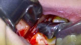 17 Surgical Extraction of Impacted Wisdom Teeth [upl. by Eciralc]