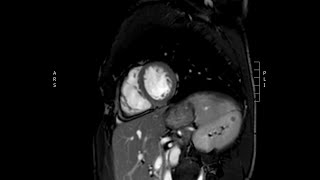 Arrhythmogenic Right Ventricular Cardiomyopathy [upl. by Trescha]