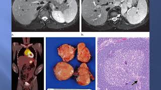 solid tumors of the peritoneum omentum and mesentery [upl. by Youngran]